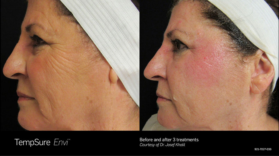 Before and After Photo | TempSure Envi | Skin Treatments