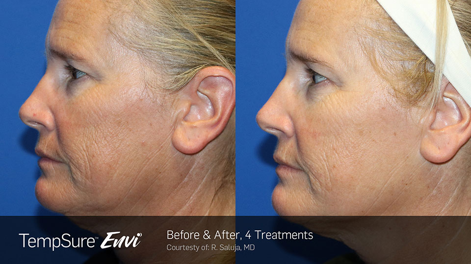 Before and After Photo | TempSure Envi | Skin Treatments