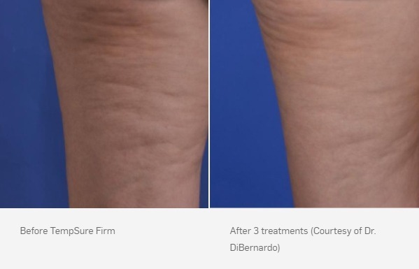 Before and After Photo | TempSure Firm | Skin Treatments