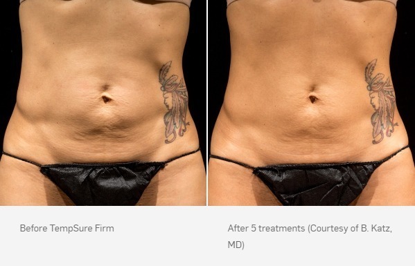 Before and After Photo | TempSure Firm | Skin Treatments
